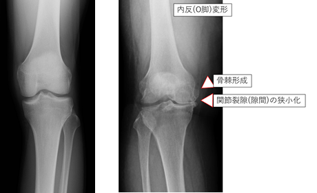 正常膝X(レントゲン)線と変形性膝関節症のX線写真